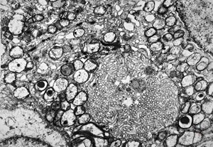 F,44y. | ependymoma F,44y. | ependymoma